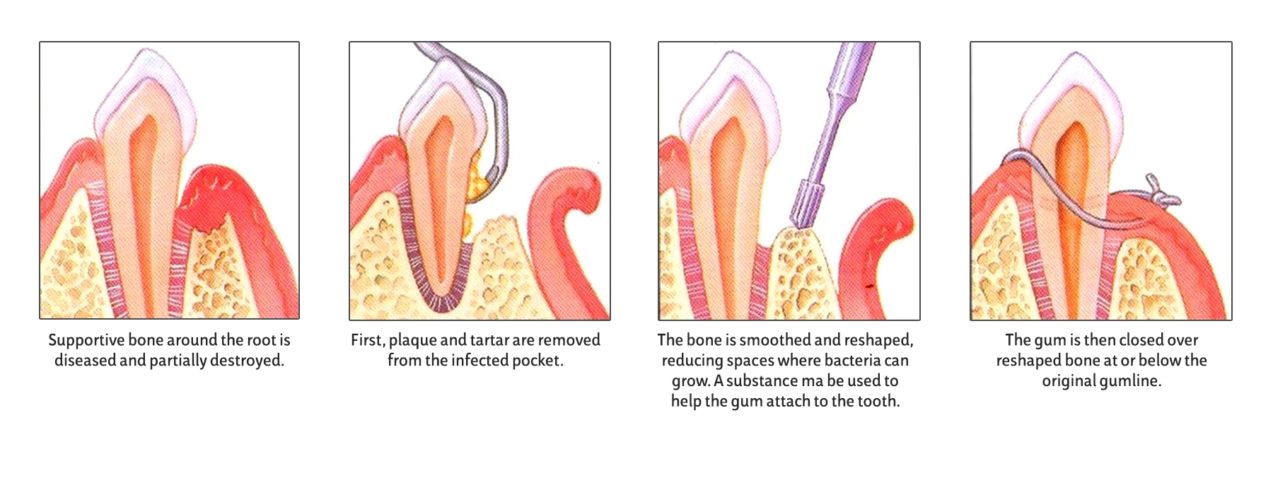 Periodontal Pocket Reduction Surgery | Tampa & New Port Richey