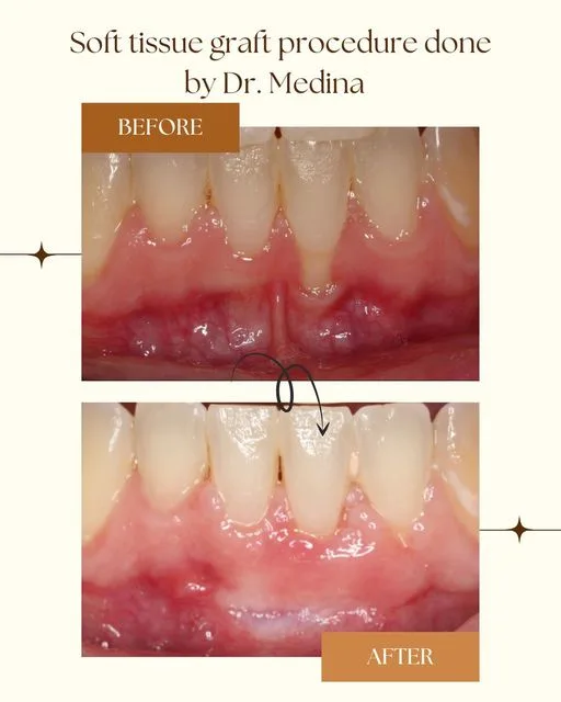 soft tissue graft procedure done by Dr. Medina